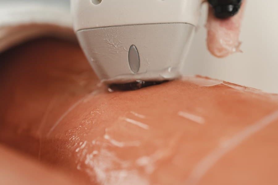 Applicateur de lumière pulsée posé sur une jambe recouverte de gel de contact